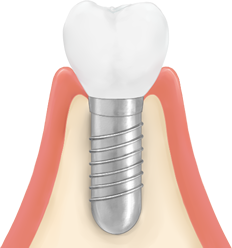 インプラント