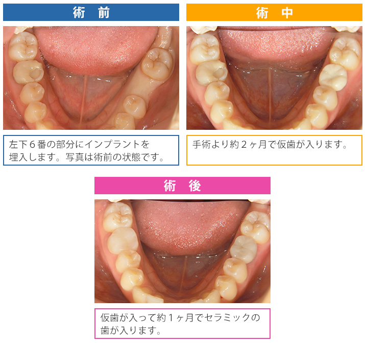 インプラント治療症例1