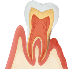 歯周病の原因