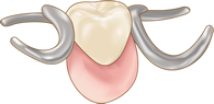 部分入れ歯