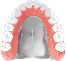 金属床義歯